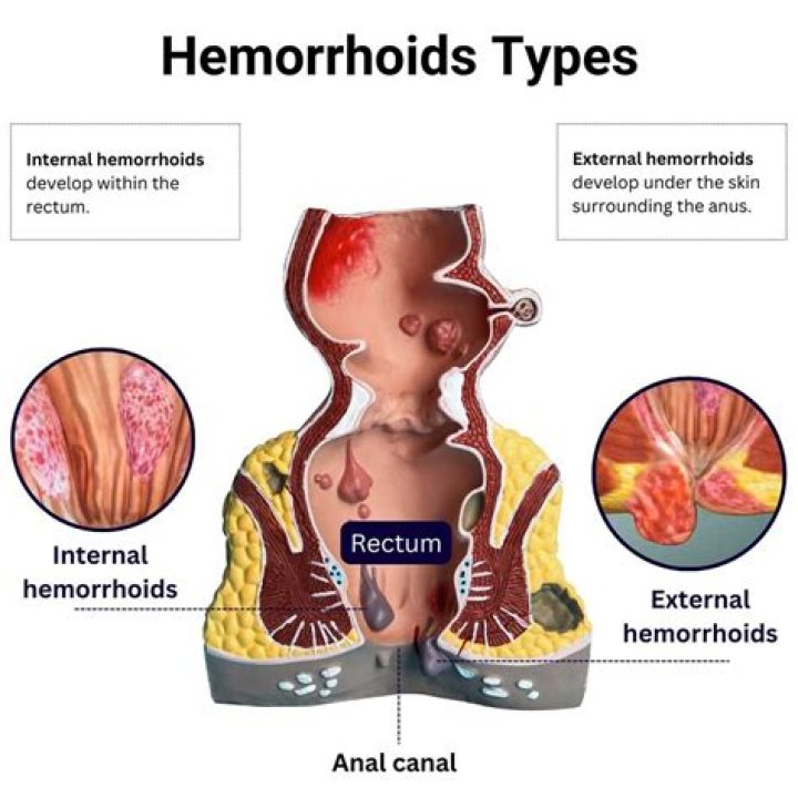 Are hemorrhoids a STD?