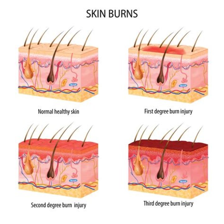 At what temp does hair Burn?