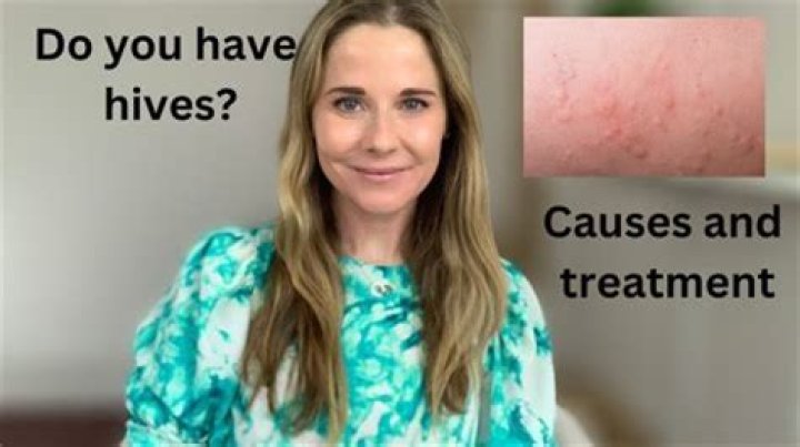 Can a dirty house cause hives?