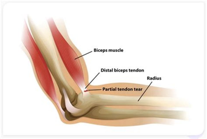 Can a torn elbow tendon heal itself?