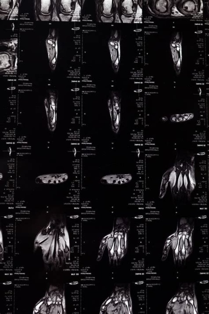 Can an MRI show nerve damage?