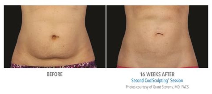 Can CoolSculpting get rid of pooch?