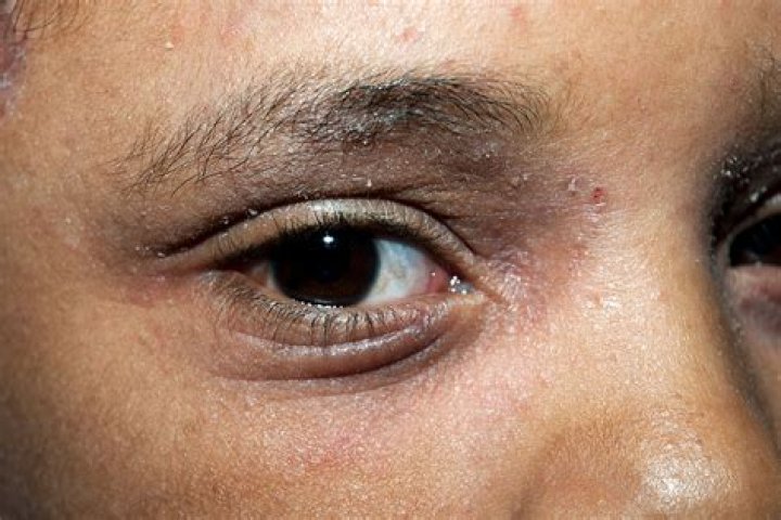 Can dry eyes come and go?
