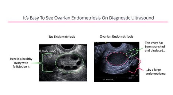 Can endometriosis be seen on ultrasound?