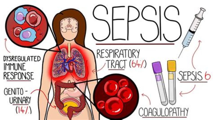 Can I get sepsis if I'm on antibiotics?