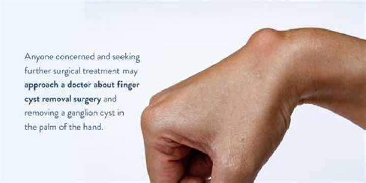 Can I go back to work after cyst removal?