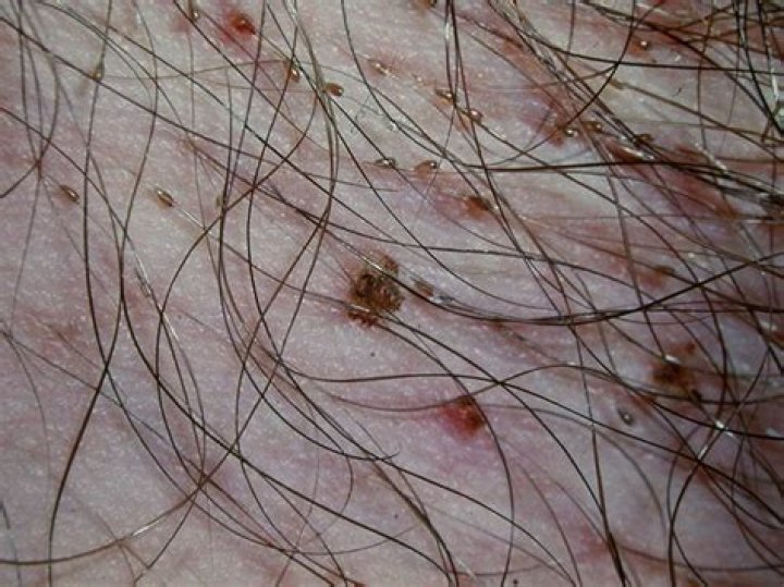 Can lice affect your skin?