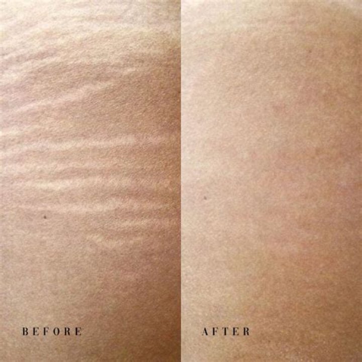 Can Shea Butter clear stretch marks?