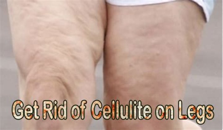 Can Squats get rid of cellulite?