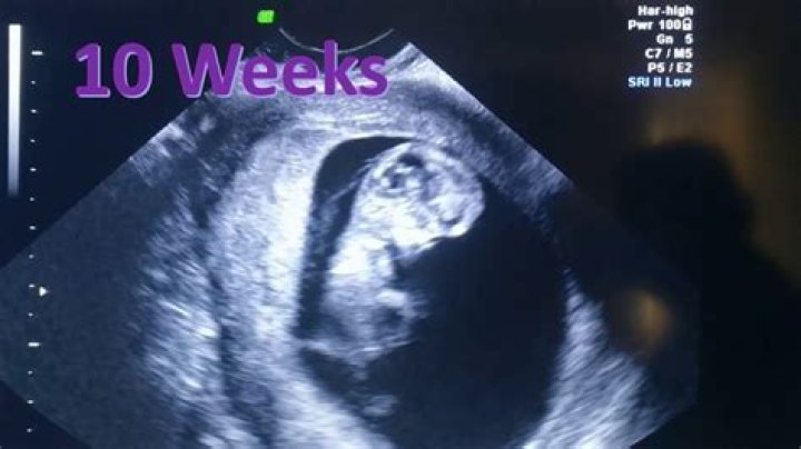 Can the baby move at 10 weeks?