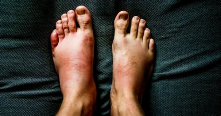 Can the beach make your feet swell?