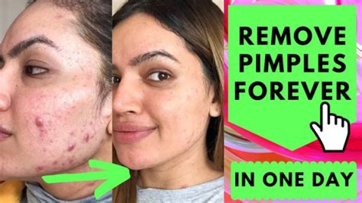 Can vitamin E remove pimples?