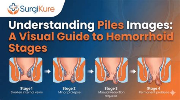 Can walking cure piles?