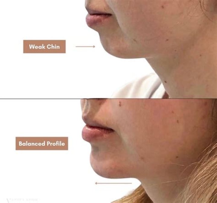 Can you be pretty with a weak chin?