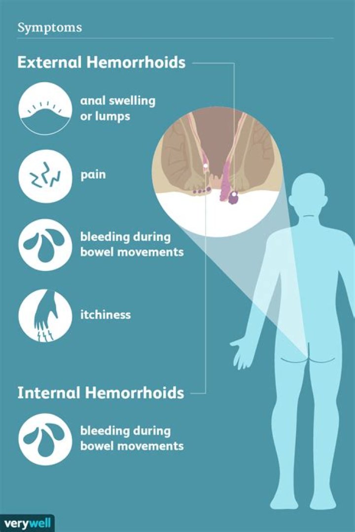 Can you bleed to death from hemorrhoids?