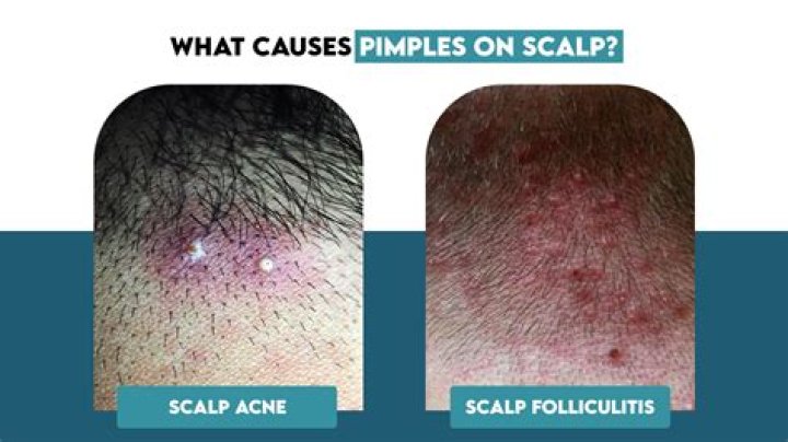 Can you get pimples on your scalp?