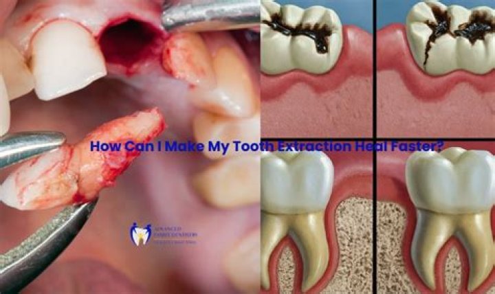 Can you get sepsis from a tooth extraction?