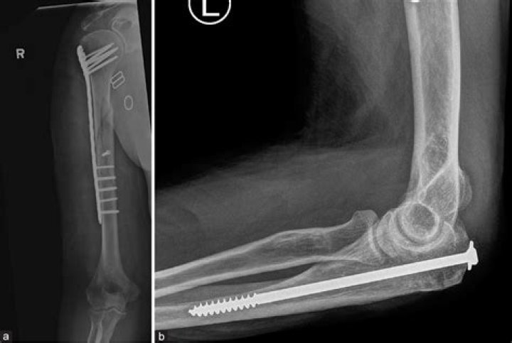 Can you have an MRI with orthopedic hardware?