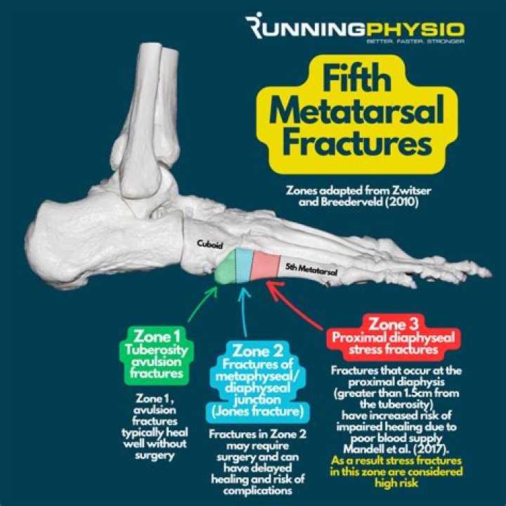 Can you still walk with a 5th metatarsal fracture?