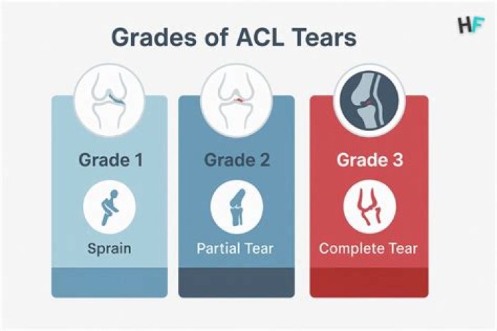 Can you walk with a Grade 3 ACL tear?