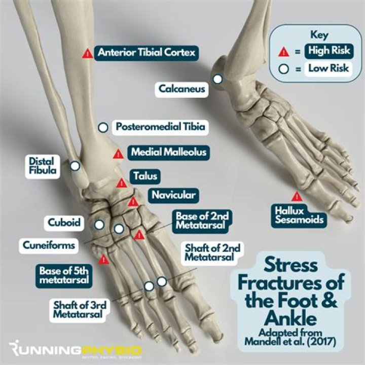 Can you walk with a stress fracture in the foot?