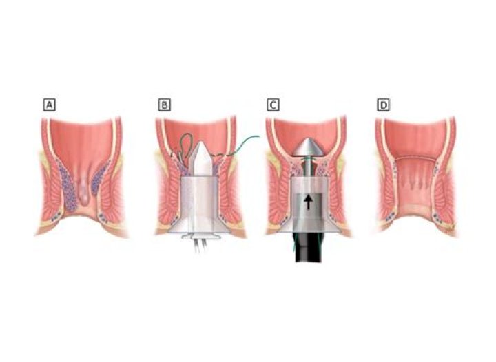Can't pee after hemorrhoid surgery?