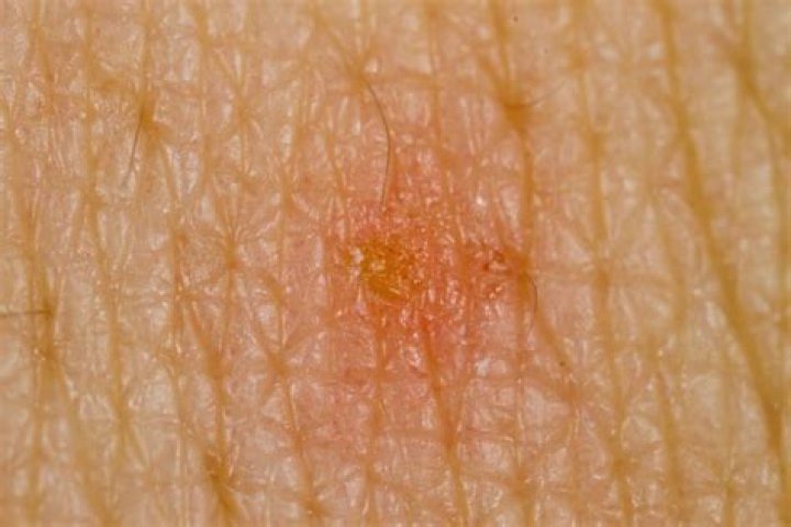 Do lice burrow under the skin?
