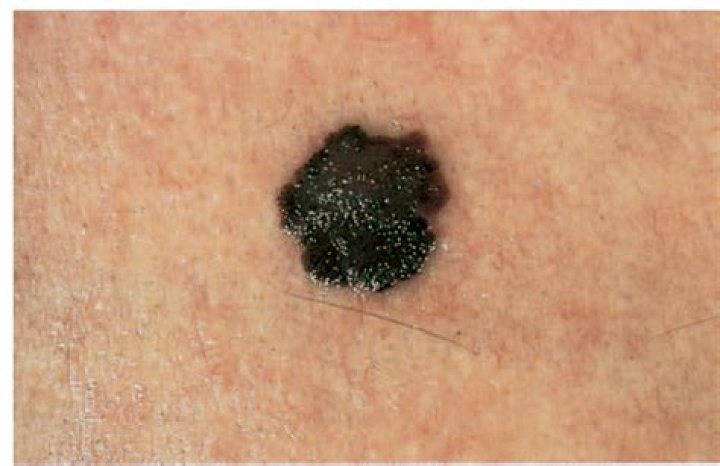 Do melanomas bleed?