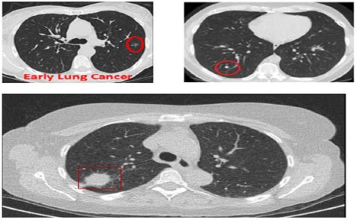 Does a lung CT scan show COPD?