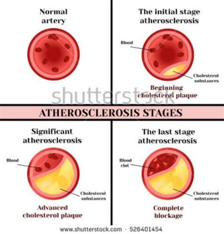 Does anything dissolve plaque in arteries?