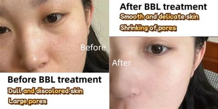 Does bbl help with acne?