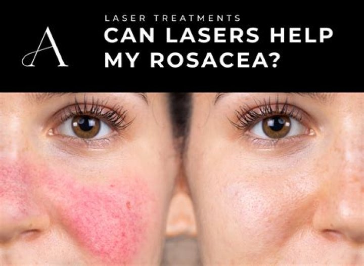 Does BBL help with rosacea?