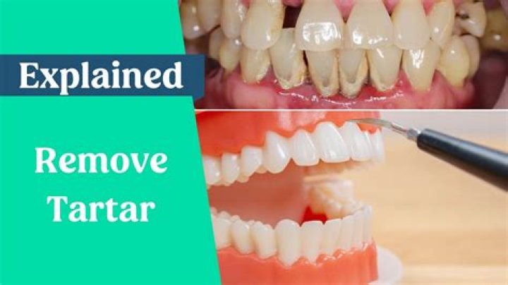 Does vinegar remove tartar from teeth?