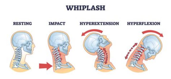 Does whiplash get worse at night?
