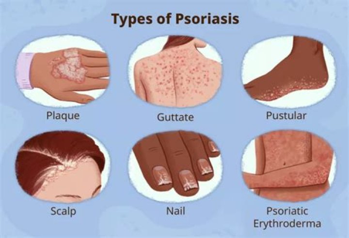 How can I cover my psoriasis at night?