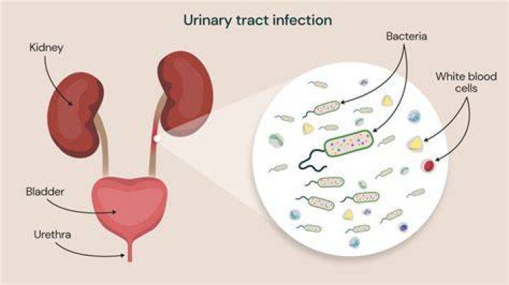 How did I get E. coli in my urinary tract?