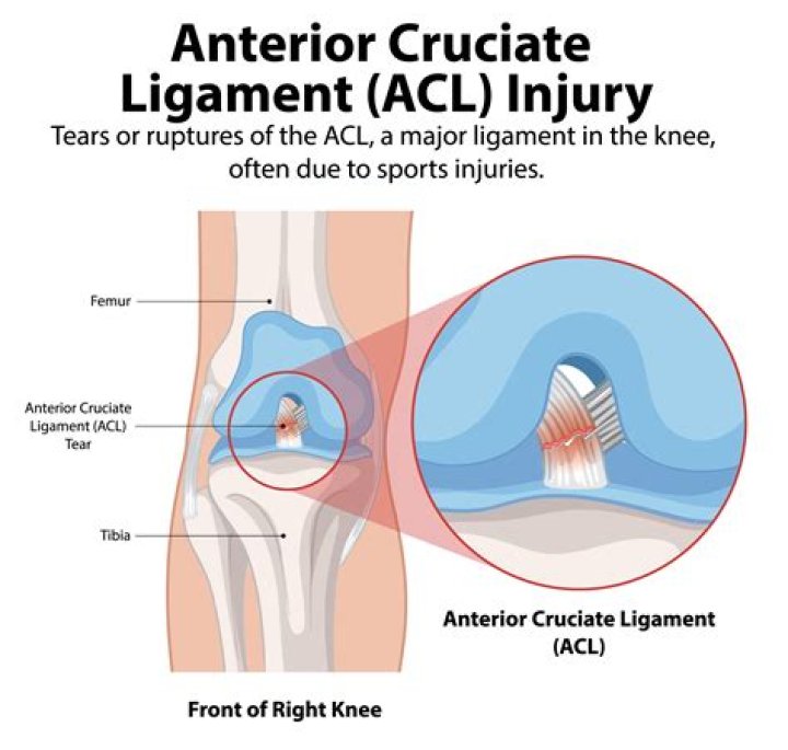 How do I know if my ACL is torn or strained?