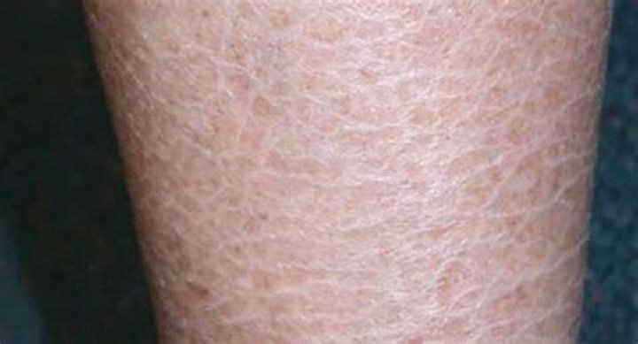 How do you get rid of ichthyosis vulgaris?
