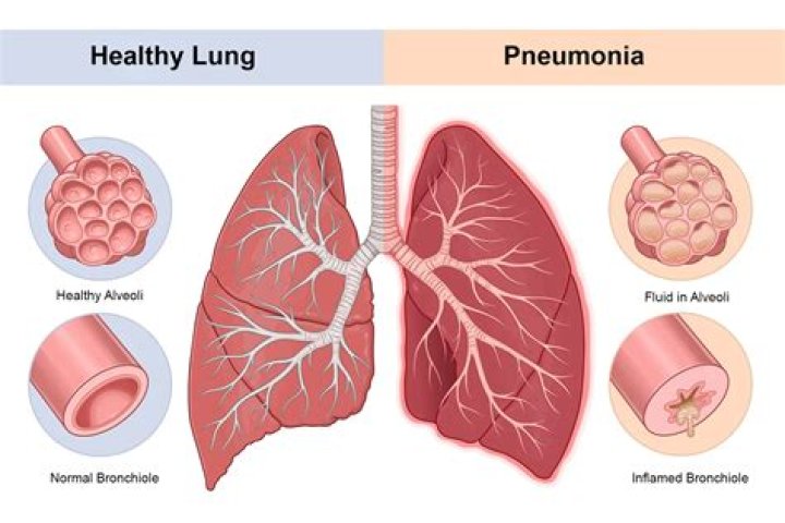 How do you know if pneumonia is getting worse?