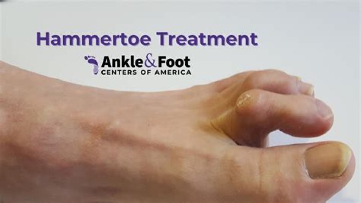 How do you permanently fix a hammer toe?