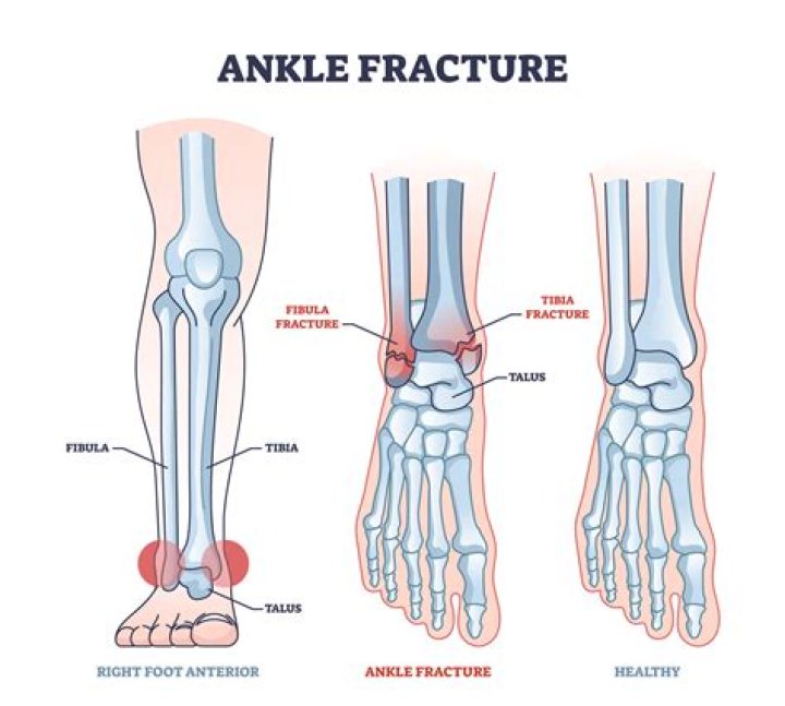 How do you tell if a foot is fractured or sprained?