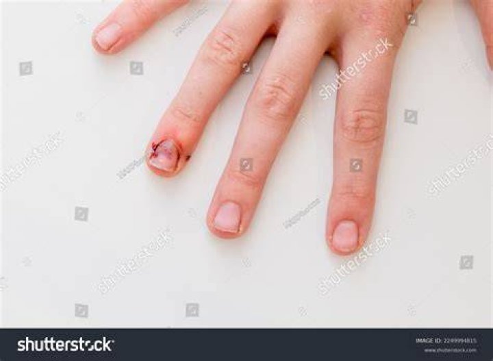 How do you tell if smashed finger is broken?