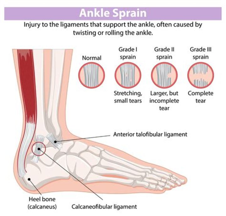 How do you treat a Grade 3 ankle sprain?