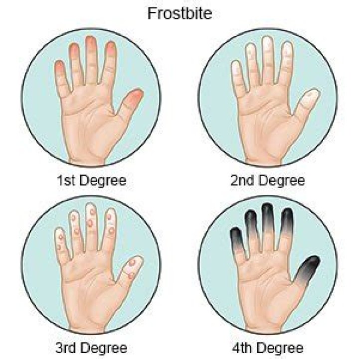 How is frostbite diagnosed?