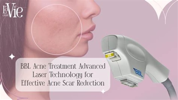 How long does it take to see BBL laser results?