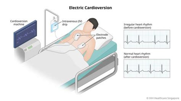 How long will a cardioversion last?