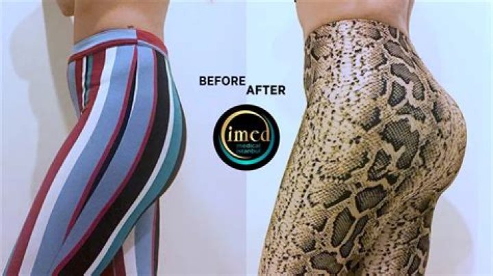 How much does a BBL cost in Mexico?