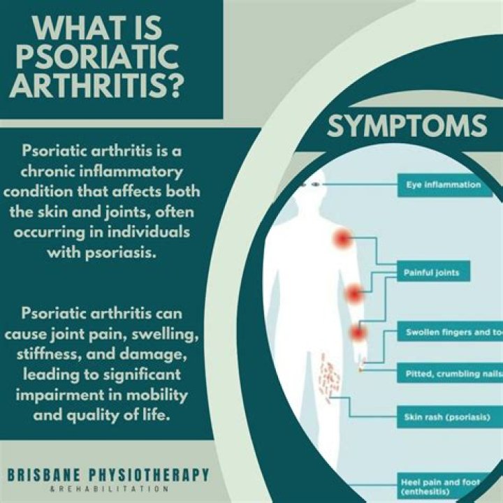 Is coffee good for psoriatic arthritis?