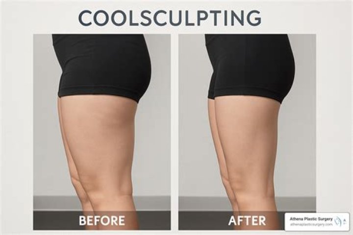 Is CoolSculpting good for outer thighs?