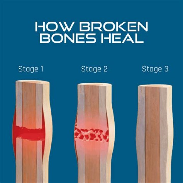 Is heat good for broken bones?